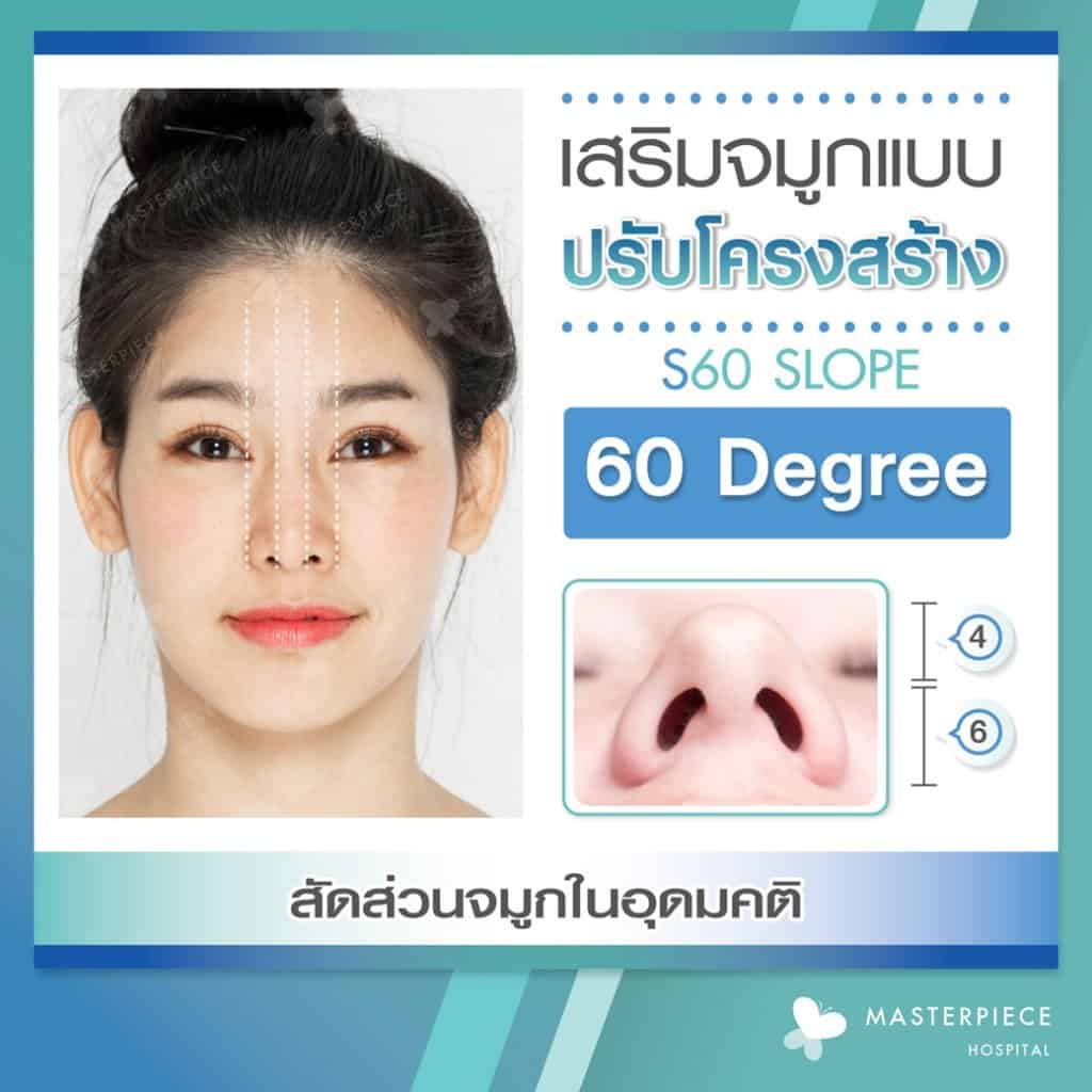 เสริมจมูก S60