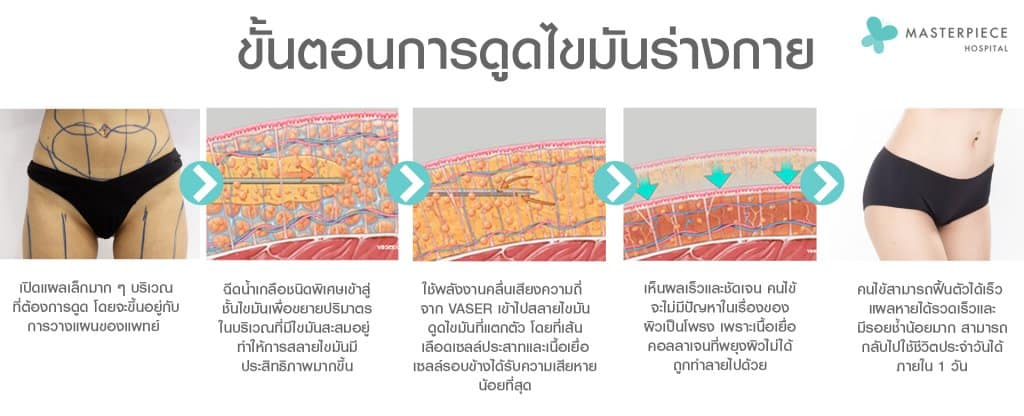ขั้นตอนการดูดไขมัน