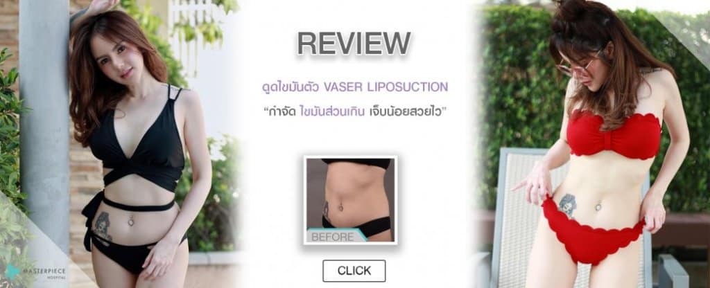 รีวิวดูดไขมันทั้งตัว VASER LIPOSUCTION