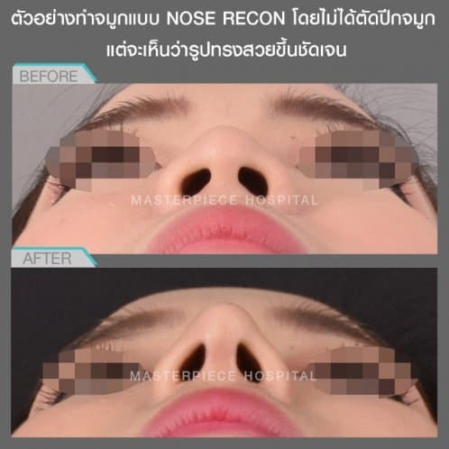 ตัวอย่างการทำจมูกแบบ NOSE RECON