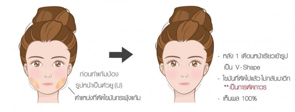 ผลลัพธ์หลังตัดไขมันกระพุ้งแก้ม (CELEBRITY CHEEK)