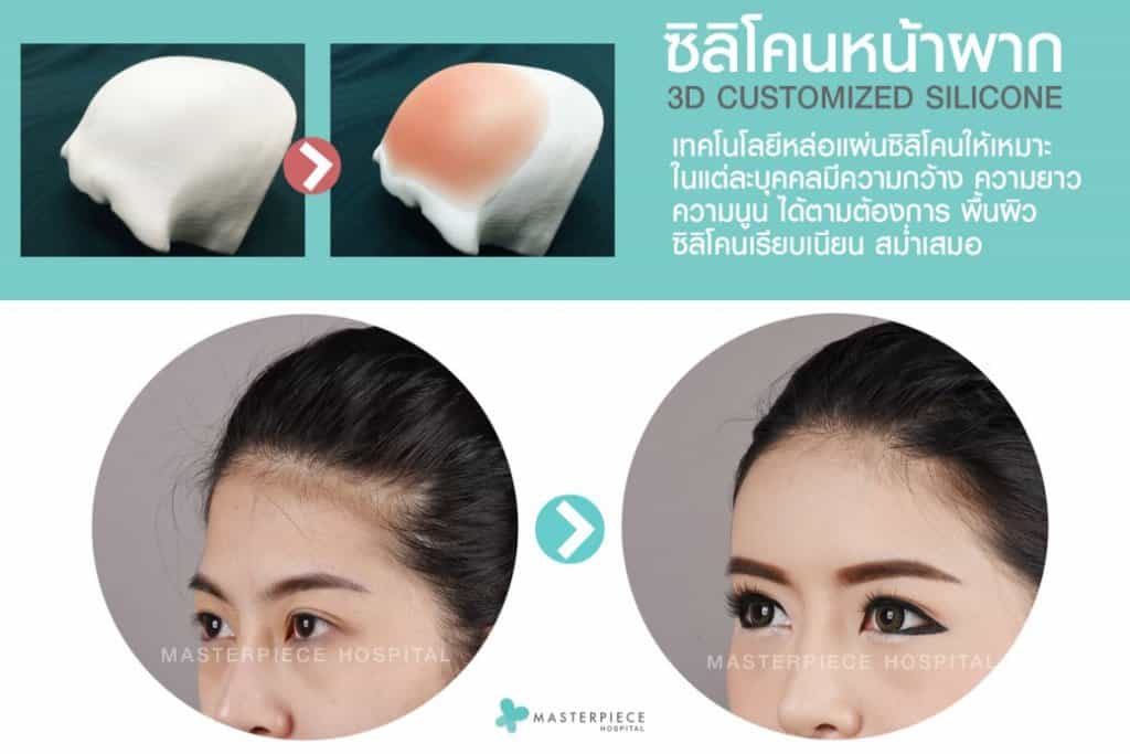 3D Customized Silicone Implant