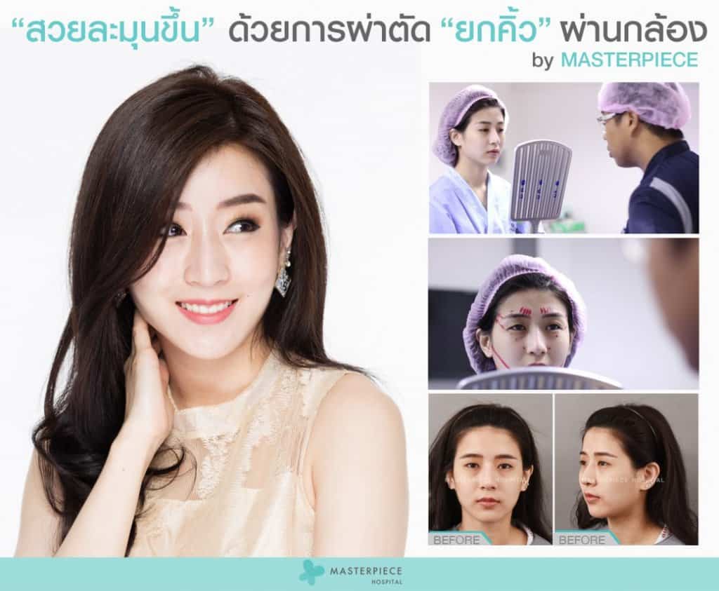 ผ่าตัดยกคิ้ว ส่องกล้อง Ad คุณพลอยแพรว