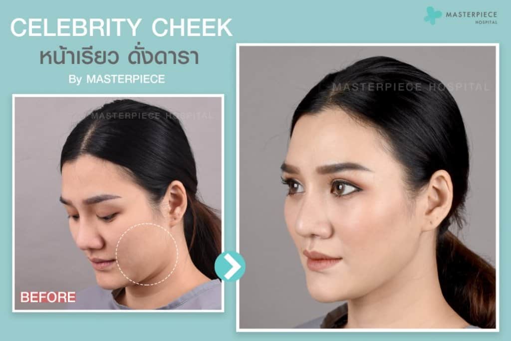 หลังการตัดไขมันกระพุ้งแก้ม (CELEBRITY CHEEK)