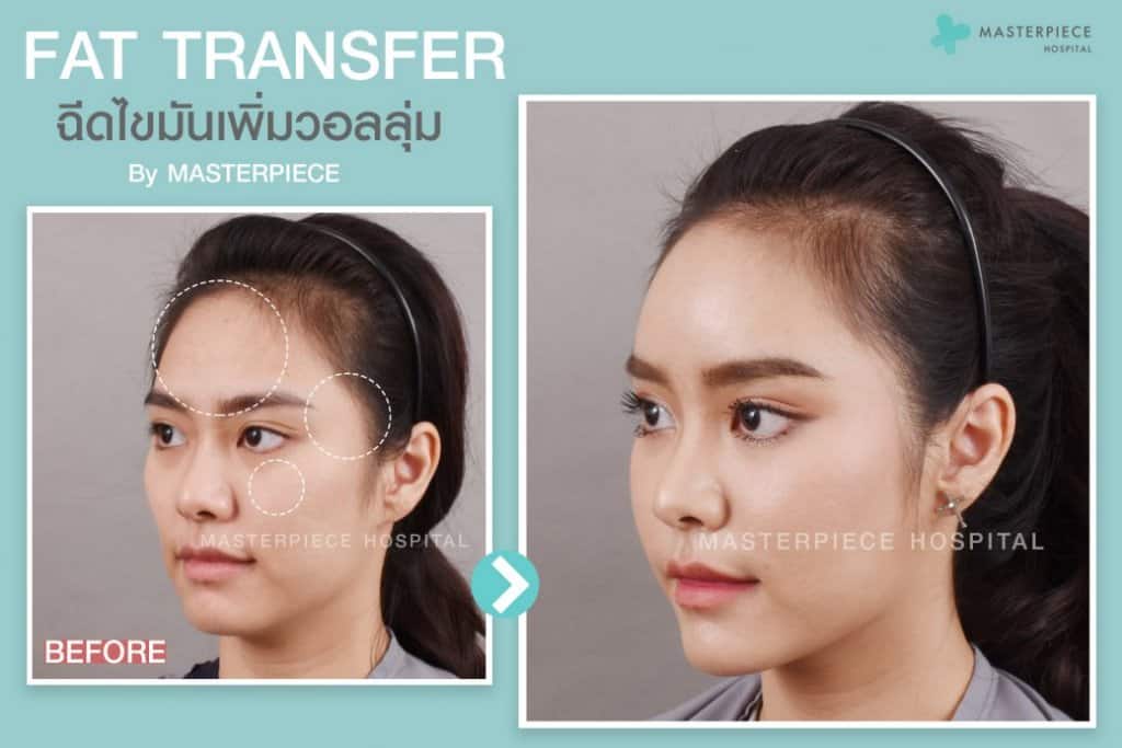 ก่อนหลังฉีดไขมันหน้า Fat Transfer