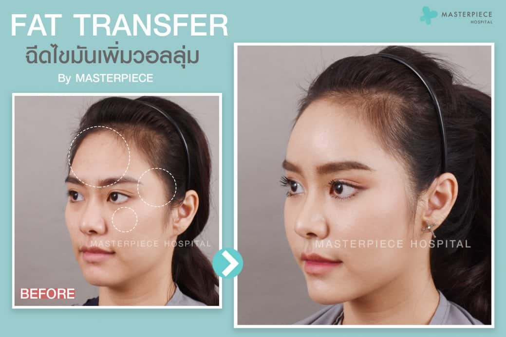 ก่อนหลัง ฉีดไขมันหน้า Fat Transfer