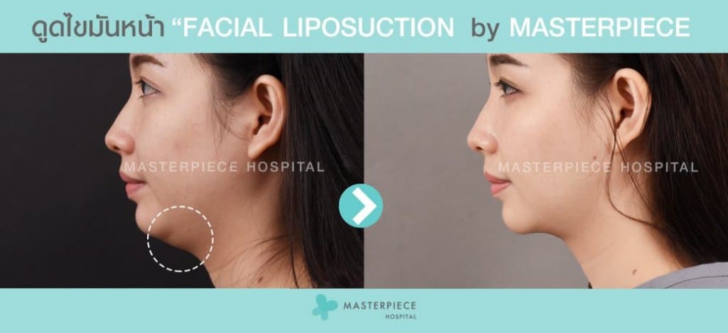 ก่อนหลัง ดูดไขมันหน้า Facial Vaser Liposuction