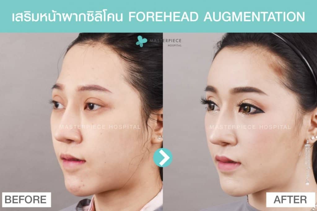 เสริมหน้าผากด้วยซิลิโคน