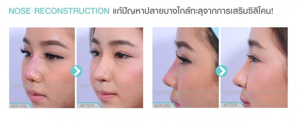 การแก้ไขเรื่องปลายจมูก