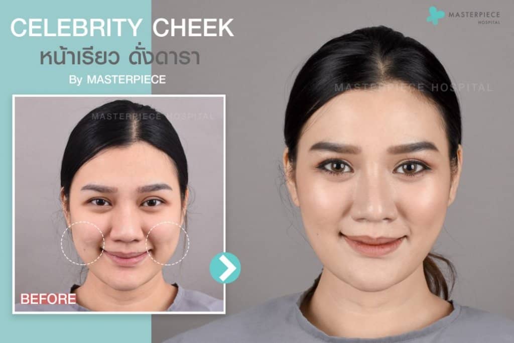 หลังการตัดไขมันกระพุ้งแก้ม (CELEBRITY CHEEK)