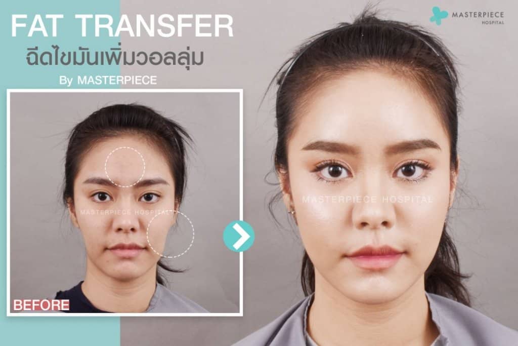 ก่อนหลังฉีดไขมันหน้าเด็ก Fat Transfer