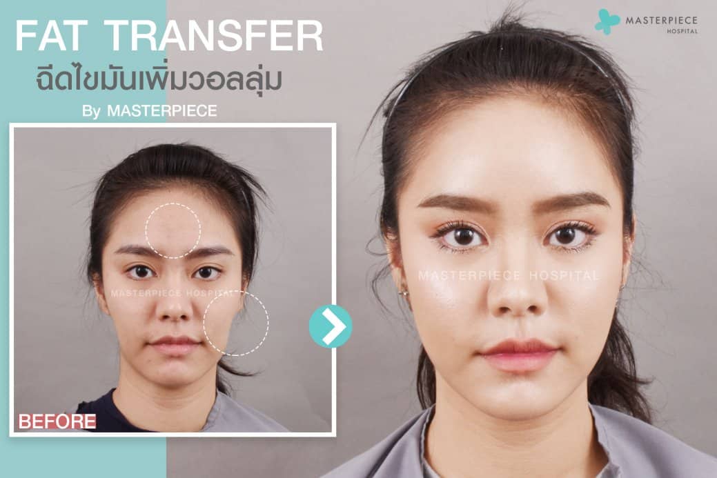 ก่อนหลัง ฉีดไขมันหน้า Fat Transfer