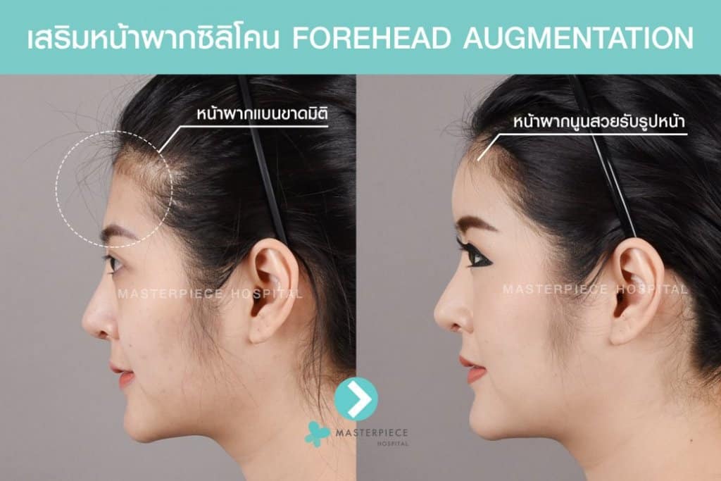 เสริมหน้าผากซิลิโคน FOREHEAD AUGMENTATION