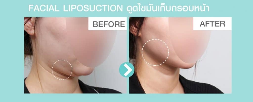 รีวิวก่อนหลัง ดูดไขมันหน้า