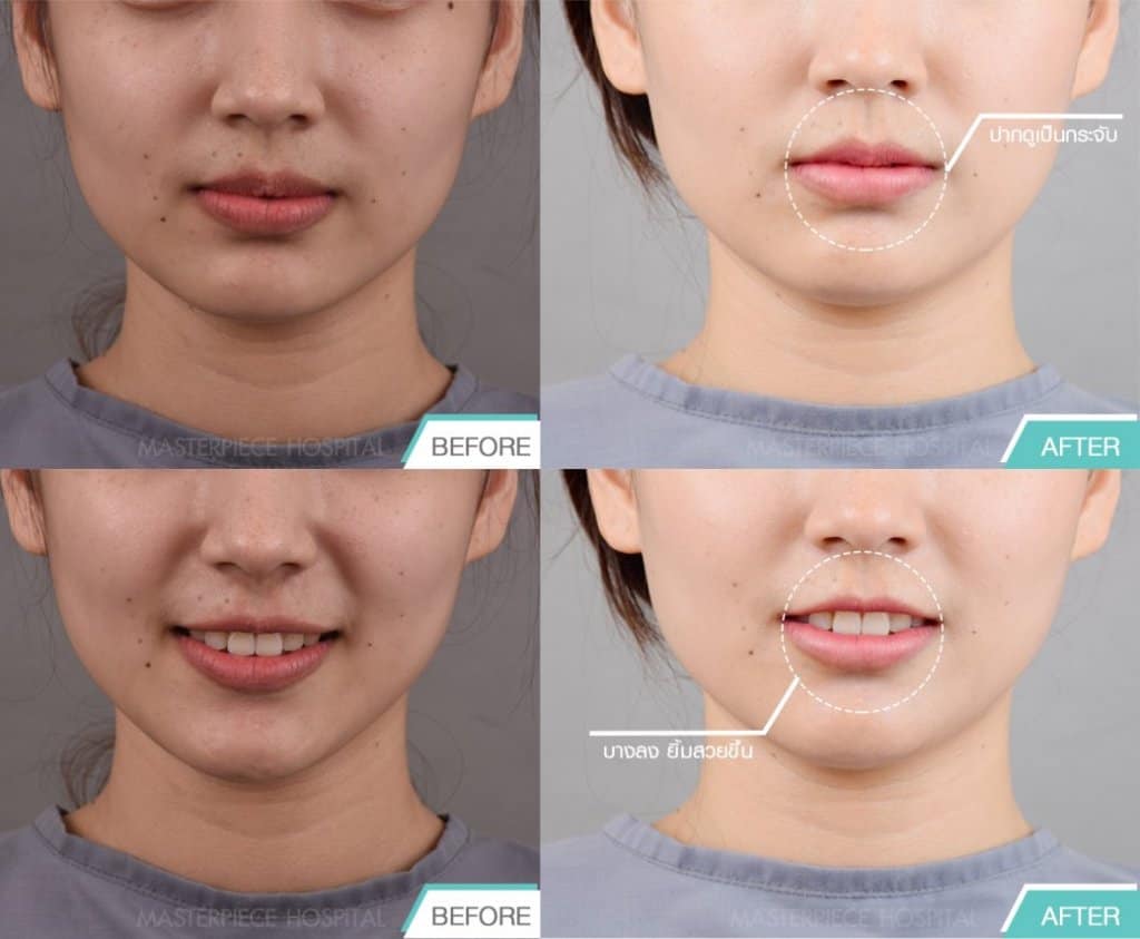 B&A ก่อนหลังทำปากกระจับ