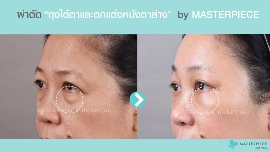 ภาพก่อนและหลังการผ่าตัดถุงใต้ตาและตกแต่งหนังตาล่าง