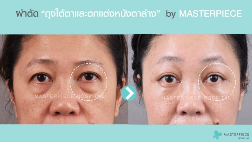 ภาพก่อน-หลังการผ่าตัดถุงใต้ตาและตกแต่งหนังตาล่าง