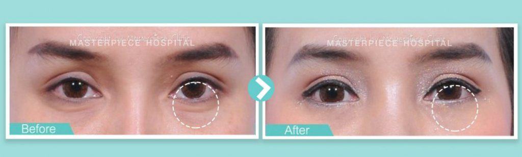 before&after กำจัดถุงใต้ตา