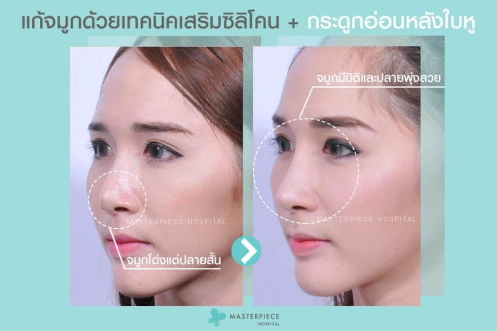 รีวิว เสริมจมูกด้วยกระดูกอ่อนหลังหู