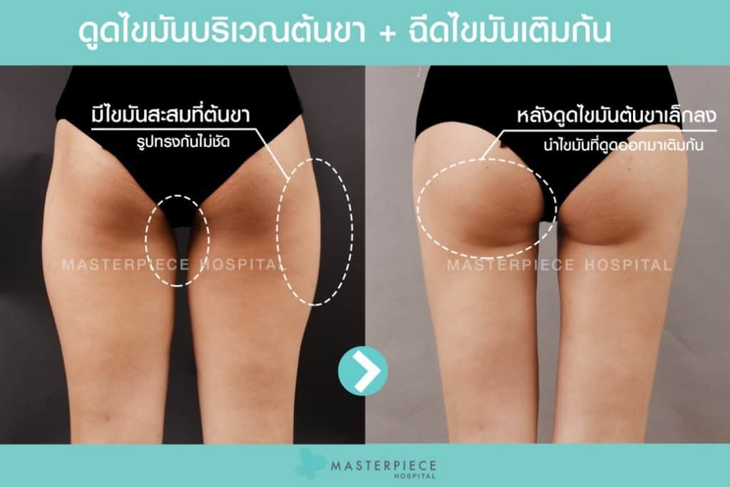 BA เติมไขมันก้น