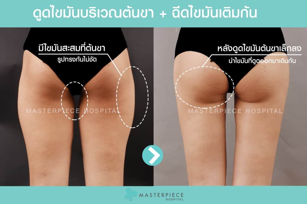 BA เติมไขมันก้น