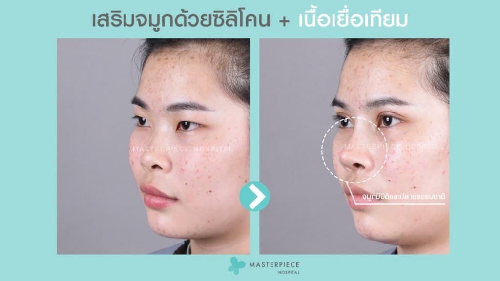 รีวิว เสริมจมูกด้วยเนื้อเยื่อเทียม