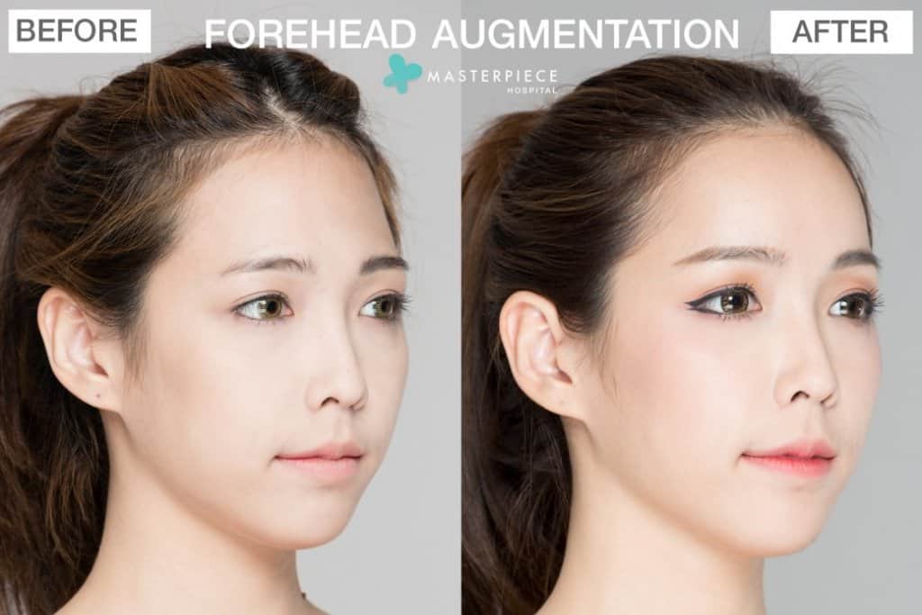 รีวิว เสริมหน้าผากซิลิโคน FOREHEAD AUGMENTATION