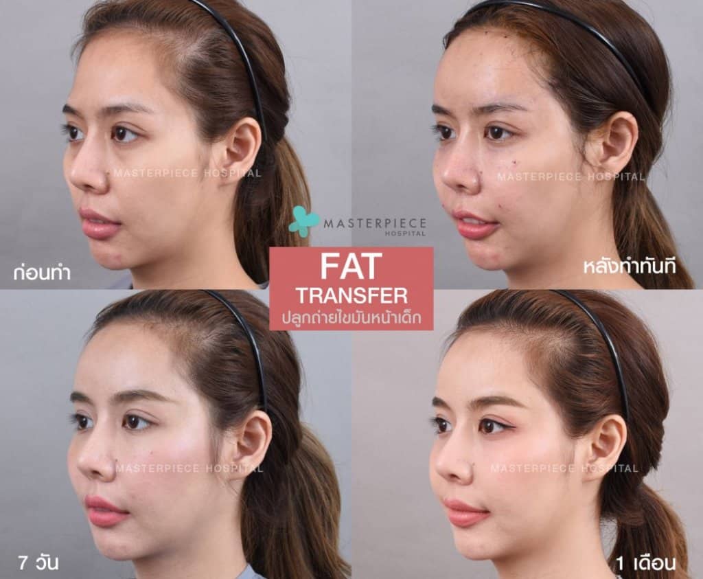 รีวิวฉีดไขมัน Fat Transfer