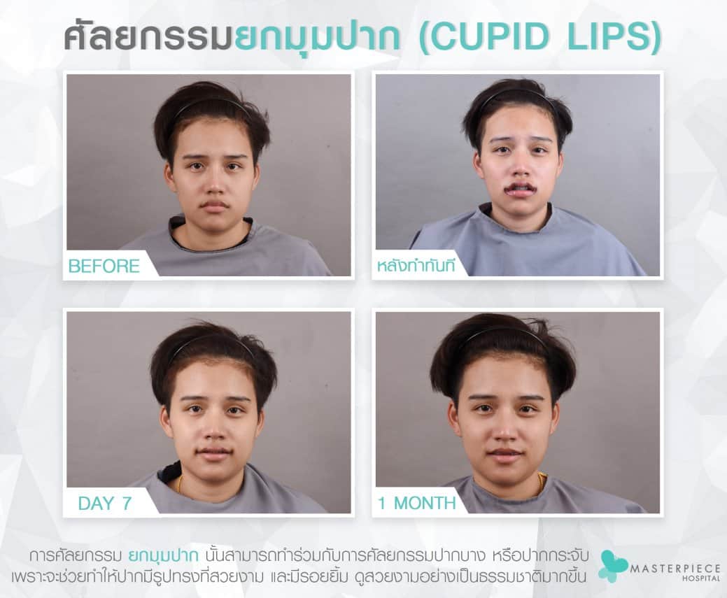 DAT TO DAT ศัลยกรรมยกมุมปาก