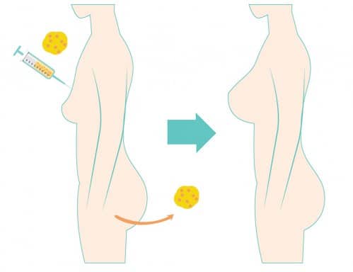 วิธีการฉีดนมด้วยไขมัน Fat Transfer