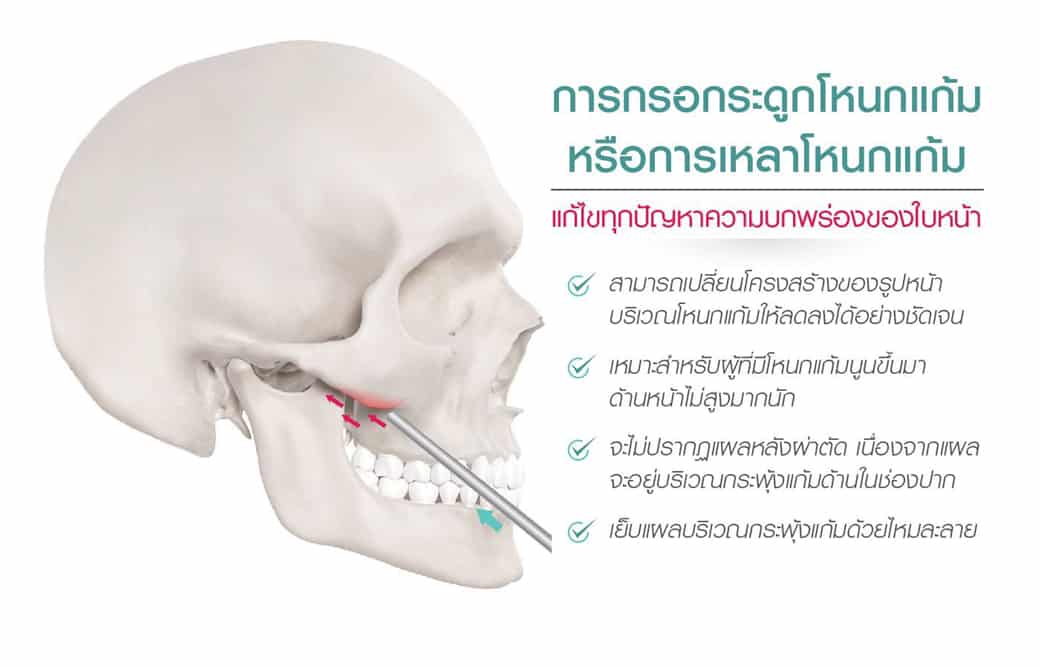 ลดโหนกแก้ม