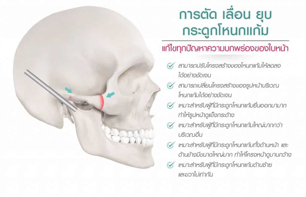 การยุบโหนกแก้ม
