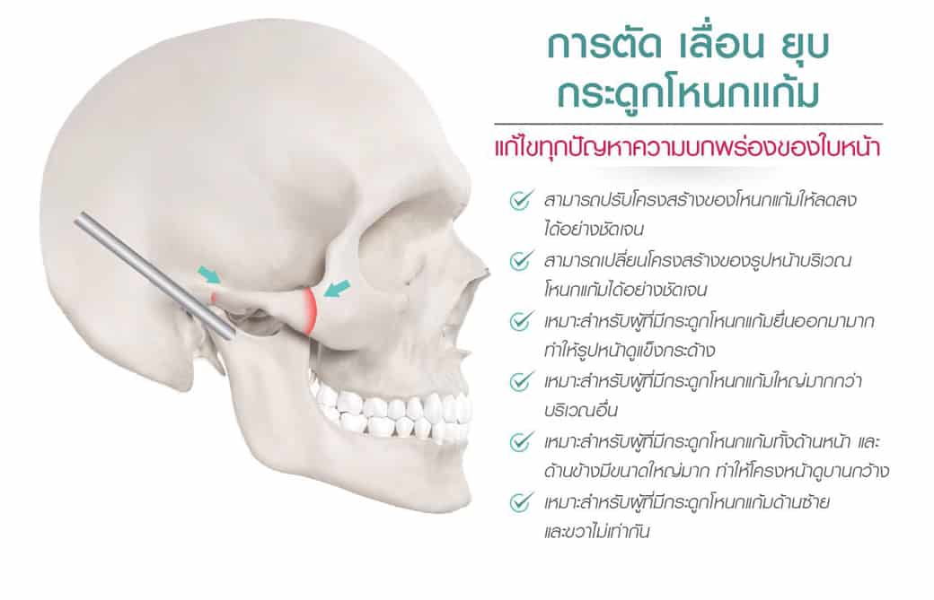 เลื่อนยุบโหนกแก้ม