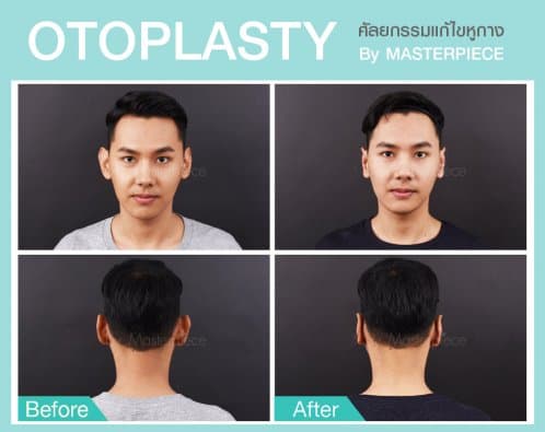 Otoplasty