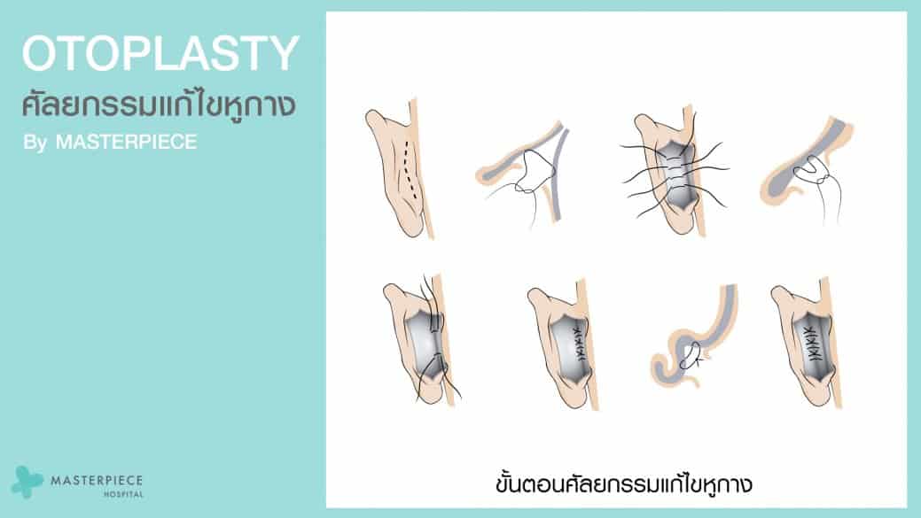 ศัลยกรรมแก้ไขหูกาง