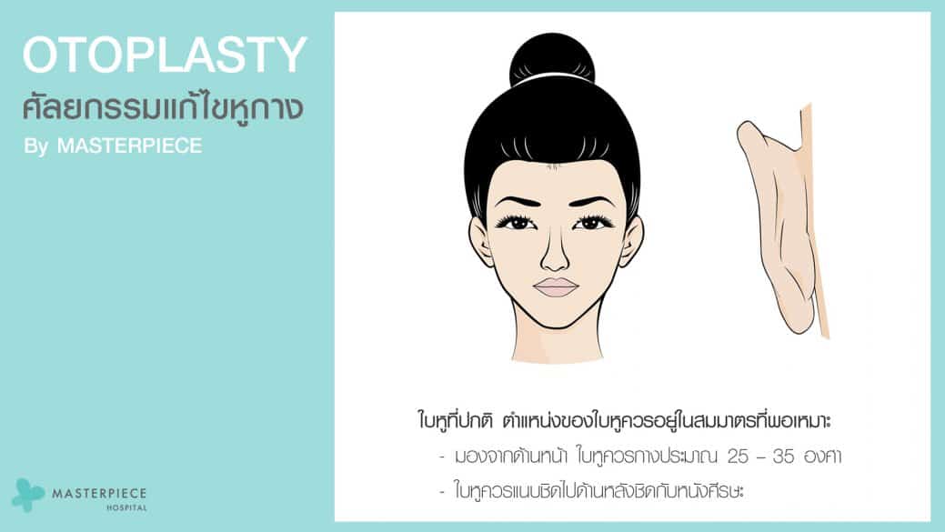 ศัลยกรรมแก้ไขหูกาง Otoplasty