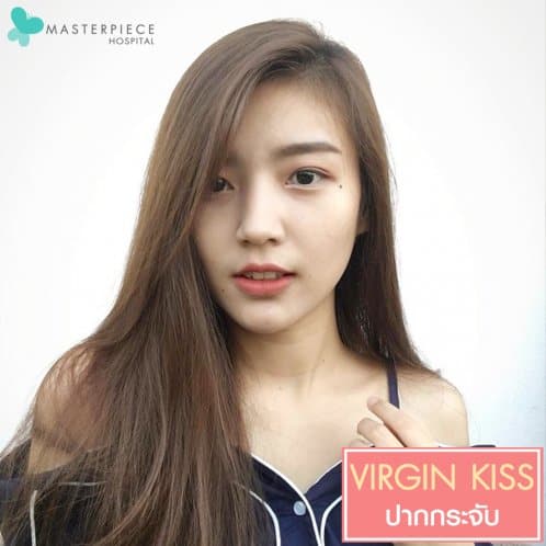 ศัลยกรรมปากกระจับ