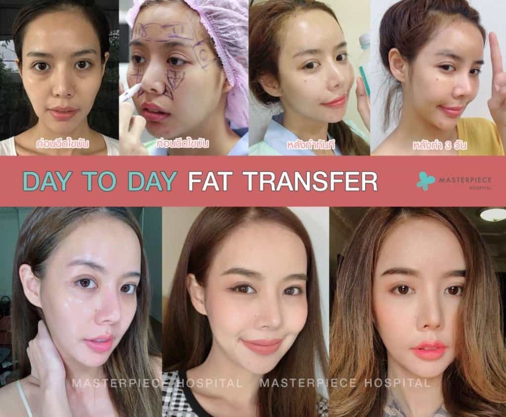 รีวิวฉีดไขมัน Fat Transfer