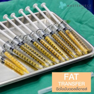 เติมชั้นใต้ตาด้วยการฉีดดอลลี่อาย Fat Transfer