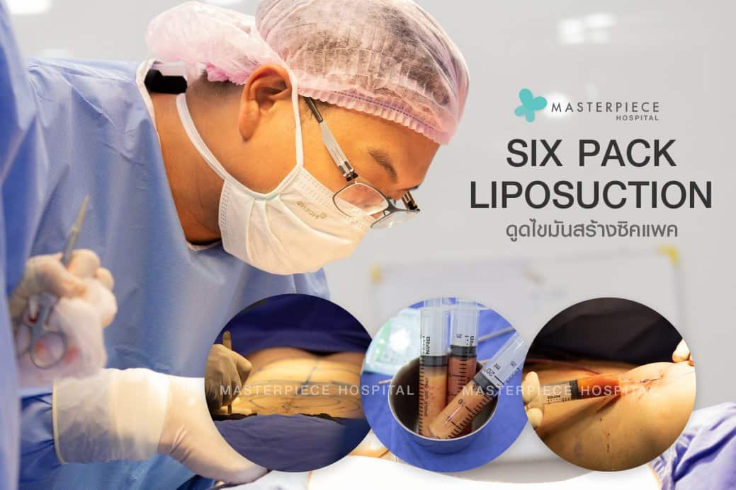 ดูดไขมัน ซิกแพค (SIX PACK LIPOSUCTION)