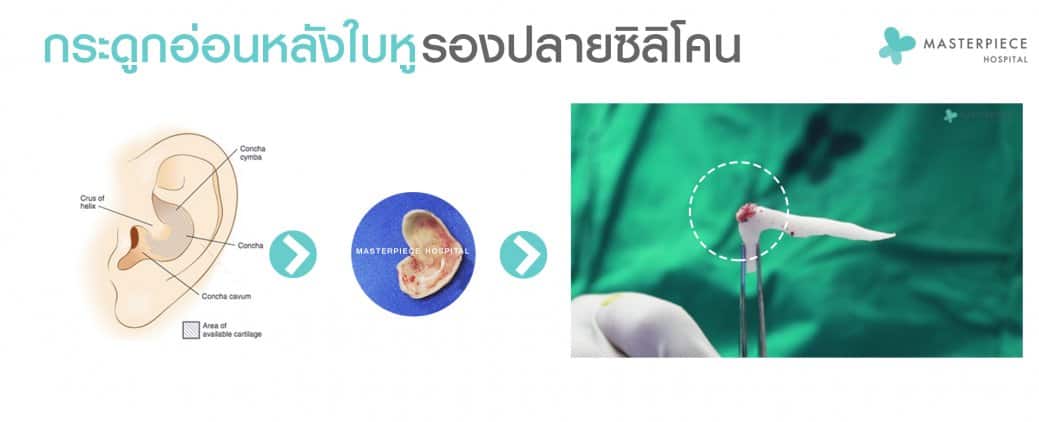 เสริมจมูกด้วยกระดูกอ่อนหลังหู
