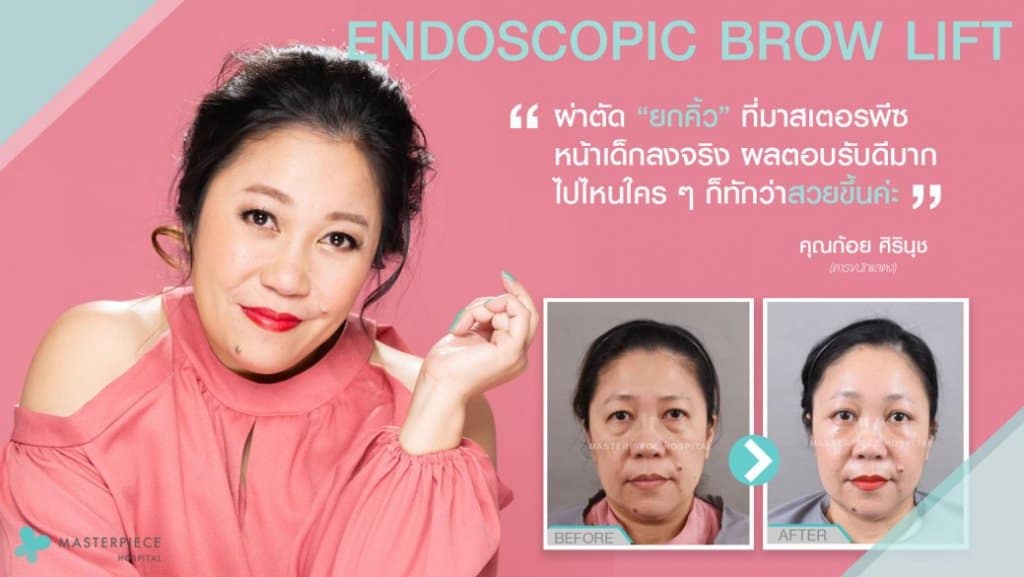 ก้อยรีวิว ยกคิ้ว (Endoscopic Brow Lift)