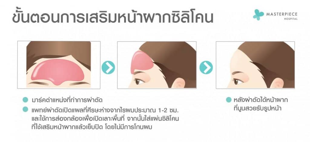 ขั้นตอนการ เสริมหน้าผากซิลิโคน