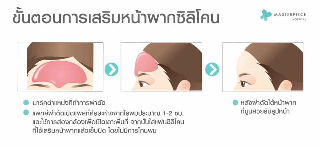 ขั้นตอนการเสริมหน้าผากซิลิโคน
