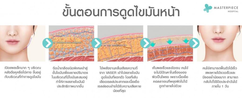ขั้นตอน ดูดไขมันหน้า Facial Vaser Liposuction