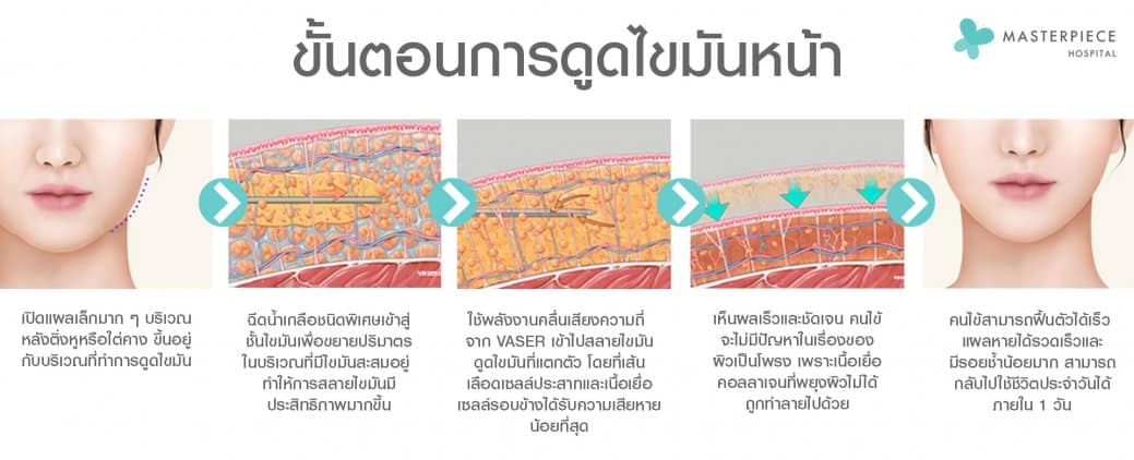ขั้นตอน ดูดไขมันหน้า Facial Vaser Liposuction