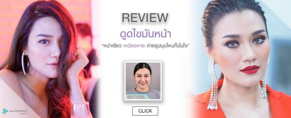 รีวิว ดูดไขมันหน้า
