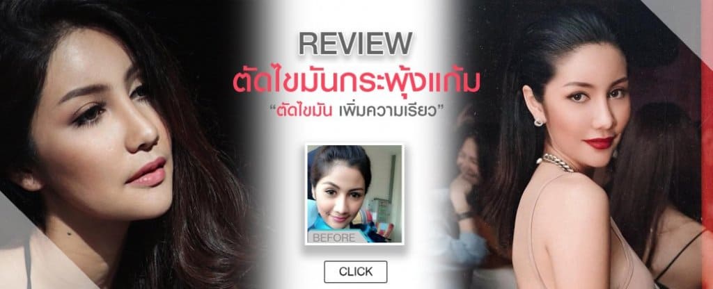 หลังการตัดไขมันกระพุ้งแก้ม