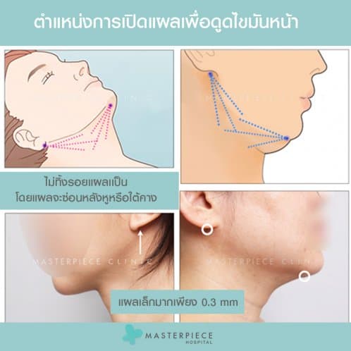 ตำแหน่งแผล ดูดไขมันหน้า