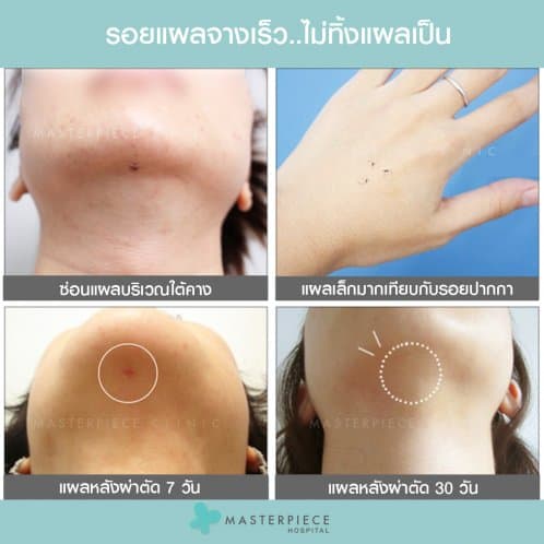 ตำแหน่งแผล ดูดไขมันหน้า